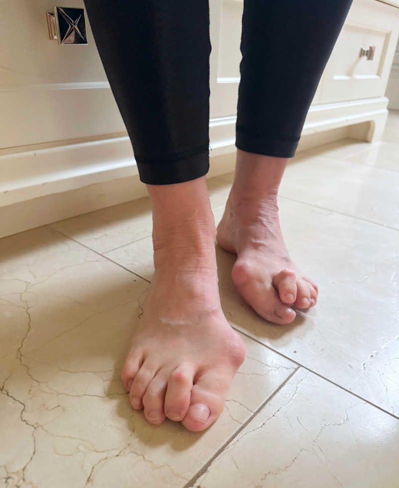 bad bunions